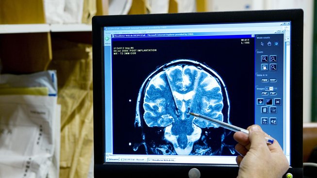 Vědci objevili možnost, jak zastavit u bojovníků obávané krvácení do mozku
