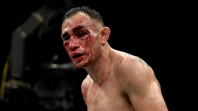 Tony Ferguson má zlomenou očnici a Niko Price vypadá jako Frankenstein. UFC 249 se neobešlo bez děsivých zranění