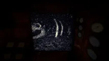 Iron Lung