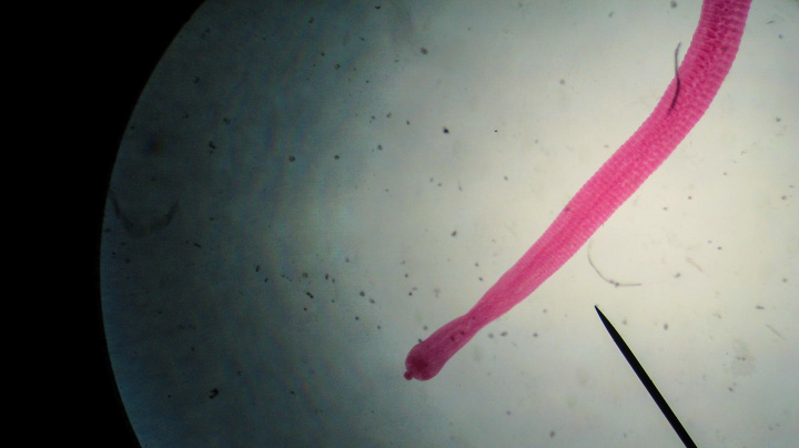 Případ jako z hororu: Muž zemřel na rakovinu vlastního parazita