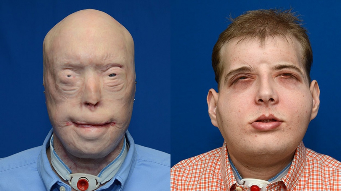 Při nejrozsáhlejší transplantaci dostal novou tvář hasič