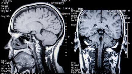 Proč máme velký mozek? Za vším je nakonec nejspíš strava
