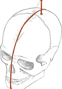 Rekonstrukce úpravy lebky