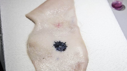 Elektronické tetování jako chytrý pomocník pro diabetiky