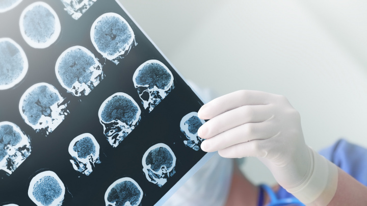 Někteří lidé jsou zřejmě imunní vůči Alzheimeru. Už tušíme, proč