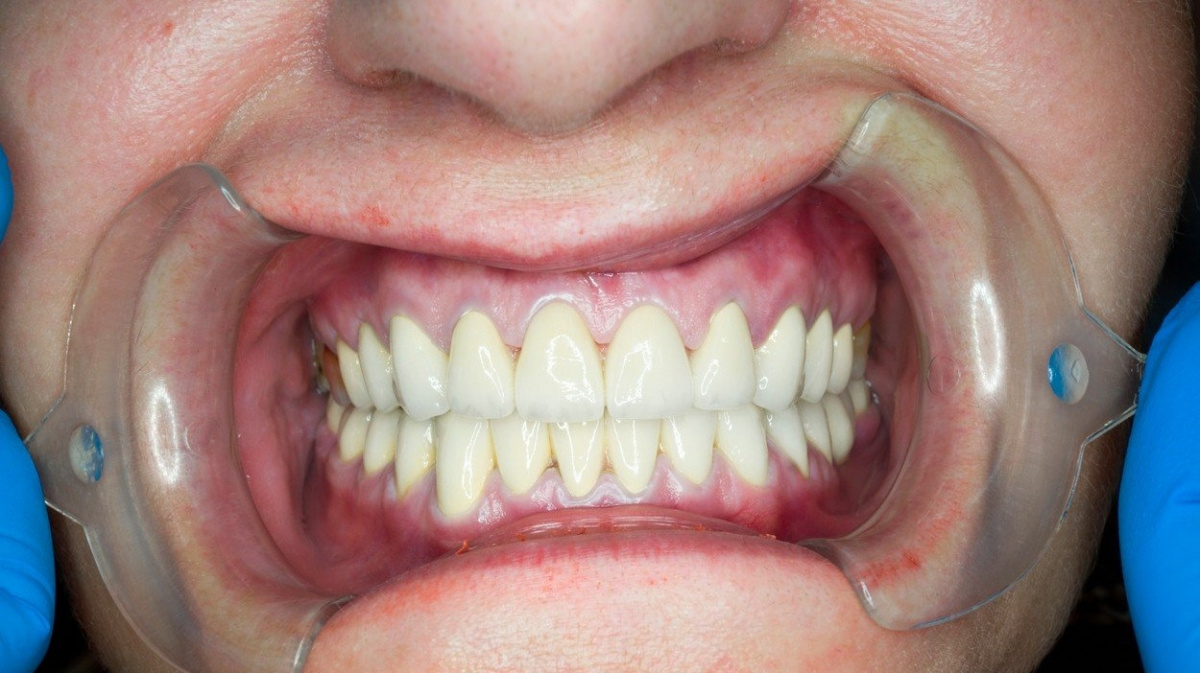 Za Alzheimerovou nemocí možná stojí bakterie způsobující paradontózu