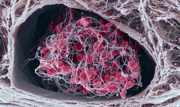 profimedia-0142944526bloodclot