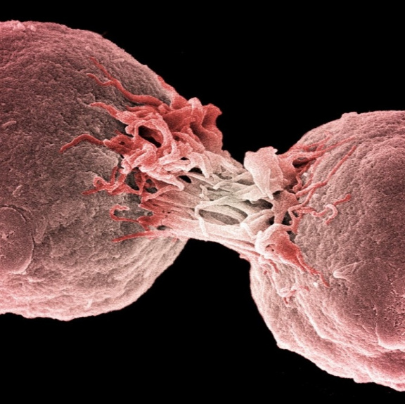 Stres může urychlovat šíření rakoviny, zjistili američtí vědci