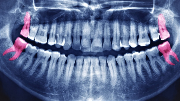 Vědci zjistili, proč nám zuby moudrosti rostou až v dospělosti