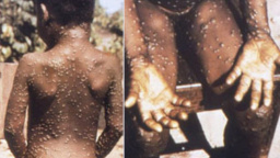 Aktualizováno: Opičí neštovice se šíří nečekaně rychle, v Česku zatím nejsou