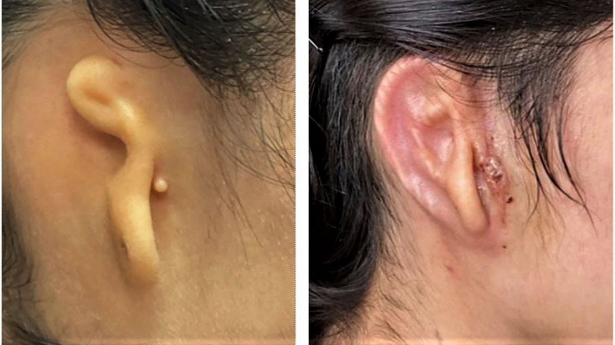 První člověk dostal ucho s vlastními buňkami vyrobené 3D tiskem