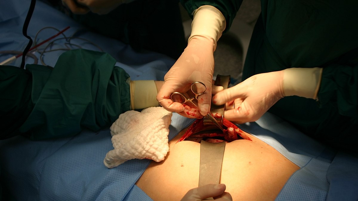 Američtí lékaři pacientovi úspěšně transplantovali prasečí ledvinu