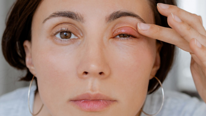 Oteklá oční víčka: Toto jsou nejčastější příčiny. Jak problém řešit?