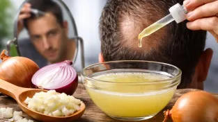 Cibulová šťáva proti vypadávání vlasů? Studie ukazuje překvapivě vysokou úspěšnost