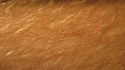 V USA vyvinuli nadějný lék proti rakovině kůže 