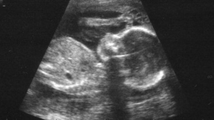 Podle britských lékařů lidský plod do 24 týdnů necítí bolest 