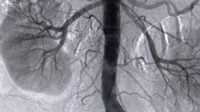 První úspěšná transplantace ledviny byla provedena před 60 lety 