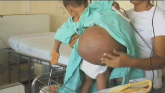 Chlapečka (2) drtil obří nádor. Byl větší než on sám