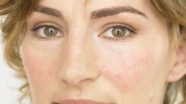 Růžovka: jak s ní bojovat