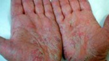 Atopický ekzém III.