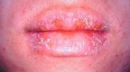 Atopický ekzém II.