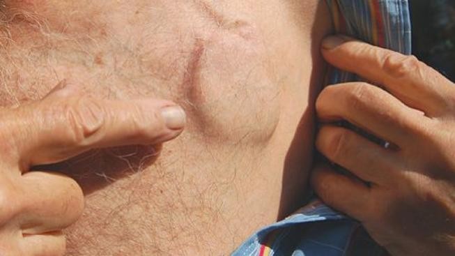 Před 30 lety byl poprvé voperován kardioverter-defibrilátor 