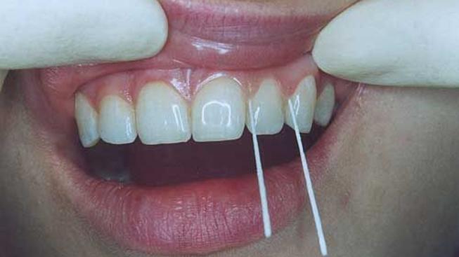 Zachráněné zuby: bezbolestně a bez vrtání 