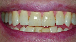 Metoda ZOOM nabízí dokonalé bělení zubů