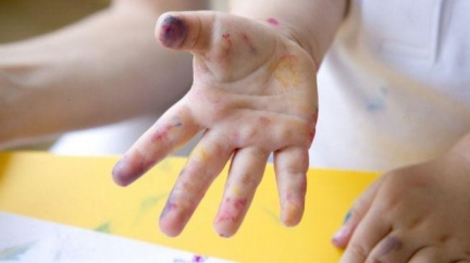 Na Vyškovsku propukla epidemie žloutenky