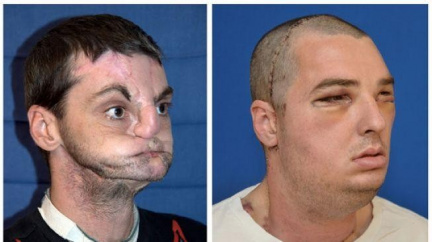 První transplantace celého obličeje se podařila. Muž dostal novou tvář, jazyk i zuby