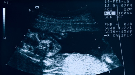 Lékaři nepovolili ženě potrat. Zemřela na otravu krve