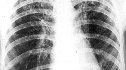 USA zaregistrovaly přelomový lék na léčbu tuberkulózy