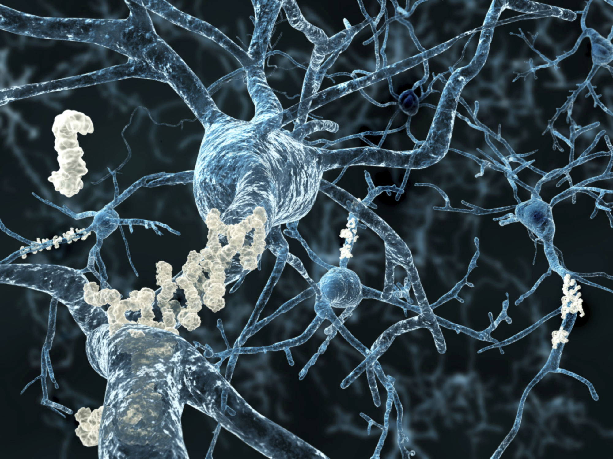 Čeští lékaři nejspíš přišli na to, jak včas zjistit Alzheimera