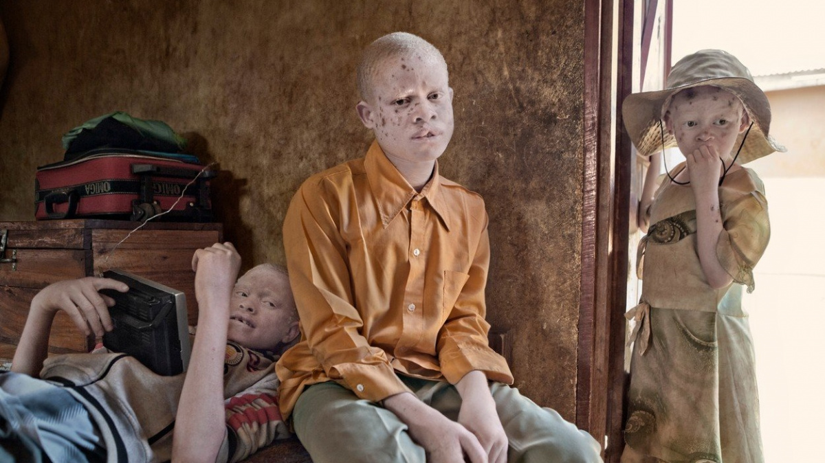 Češi zachraňují ghanské albíny