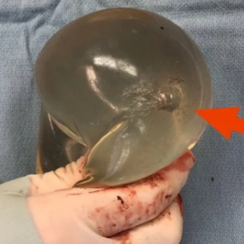 Prsní implantát zachránil ženě život. Odklonil kulku od srdce