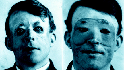 Dějiny plastické chirurgie odstartoval námořník se spáleným obličejem