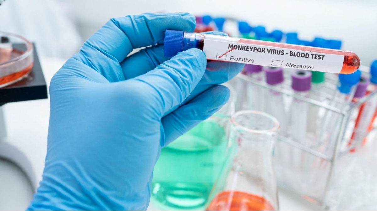 V Česku zemřel první pacient s opičími neštovicemi