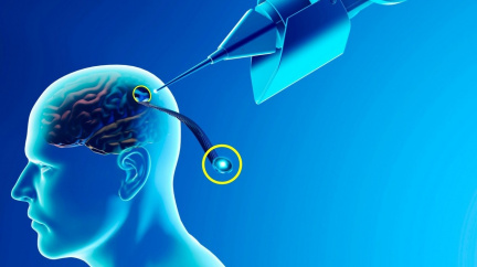 Muskova firma Neuralink implantovala mozkový čip prvnímu člověku