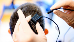 Žena byla 18 let "uzamčena" ve vlastním mozku. Řešení připomíná sci-fi