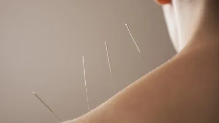Akupunktura rozděluje svět medicíny. Funguje, nebo jde jen o placebo?