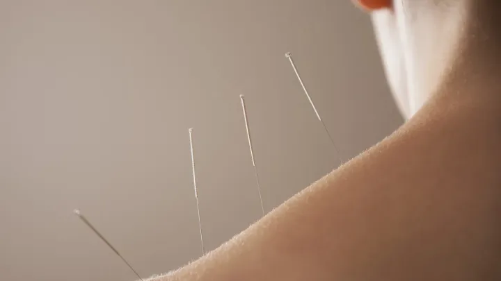 Akupunktura rozděluje svět medicíny. Funguje, nebo jde jen o placebo?