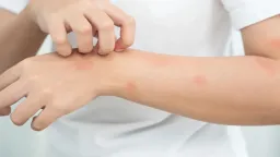 Alergie na vodu, slunce i cvičení. Pět neuvěřitelných reakcí, které skutečně existují