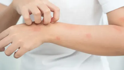 Alergie na vodu, slunce i cvičení. Pět neuvěřitelných reakcí, které skutečně existují